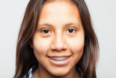 Dental Braces