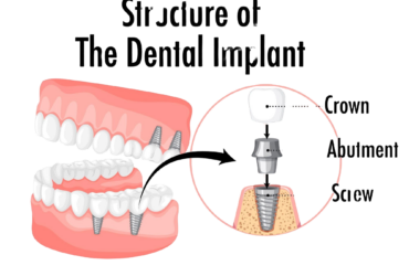 DENTAL IMPLANTS