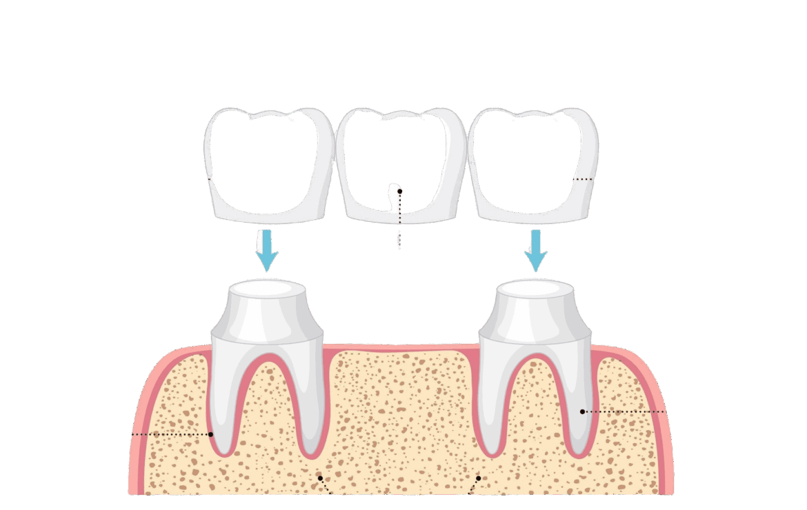 Dental Bridge Options: Fixed, Cantilever & Implant-Supported