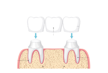DENTAL BRIDGES