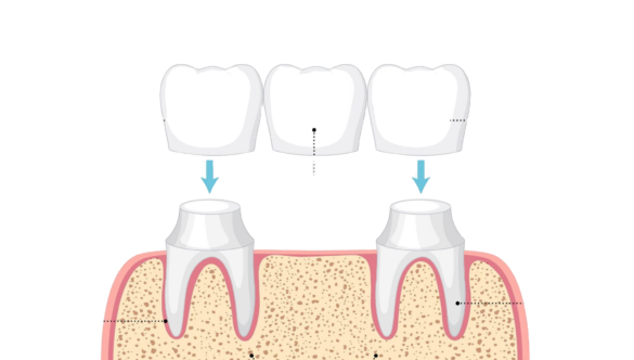 Dental Bridge Options: Fixed, Cantilever & Implant-Supported