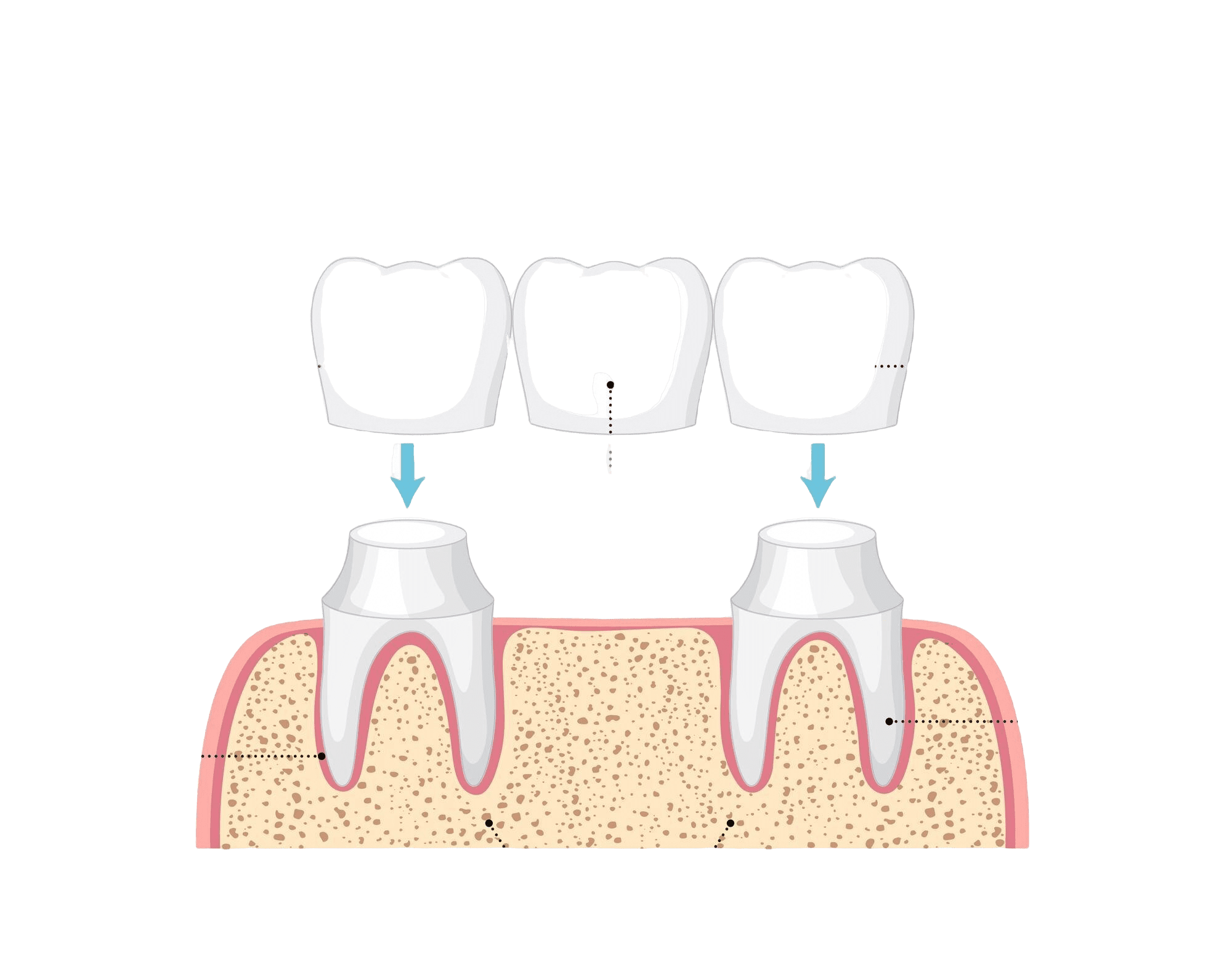 Dental Bridge Options: Fixed, Cantilever & Implant-Supported
