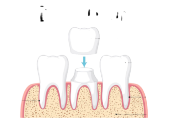 DENTAL CROWNS