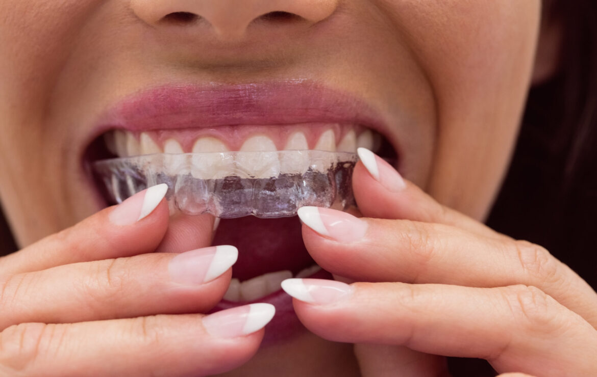 Clear Aligners: Invisible Braces for Perfect Smile