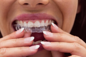 Clear Aligners: Invisible Braces for Perfect Smile