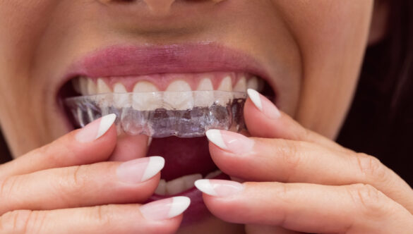 Clear Aligners: Invisible Braces for Perfect Smile
