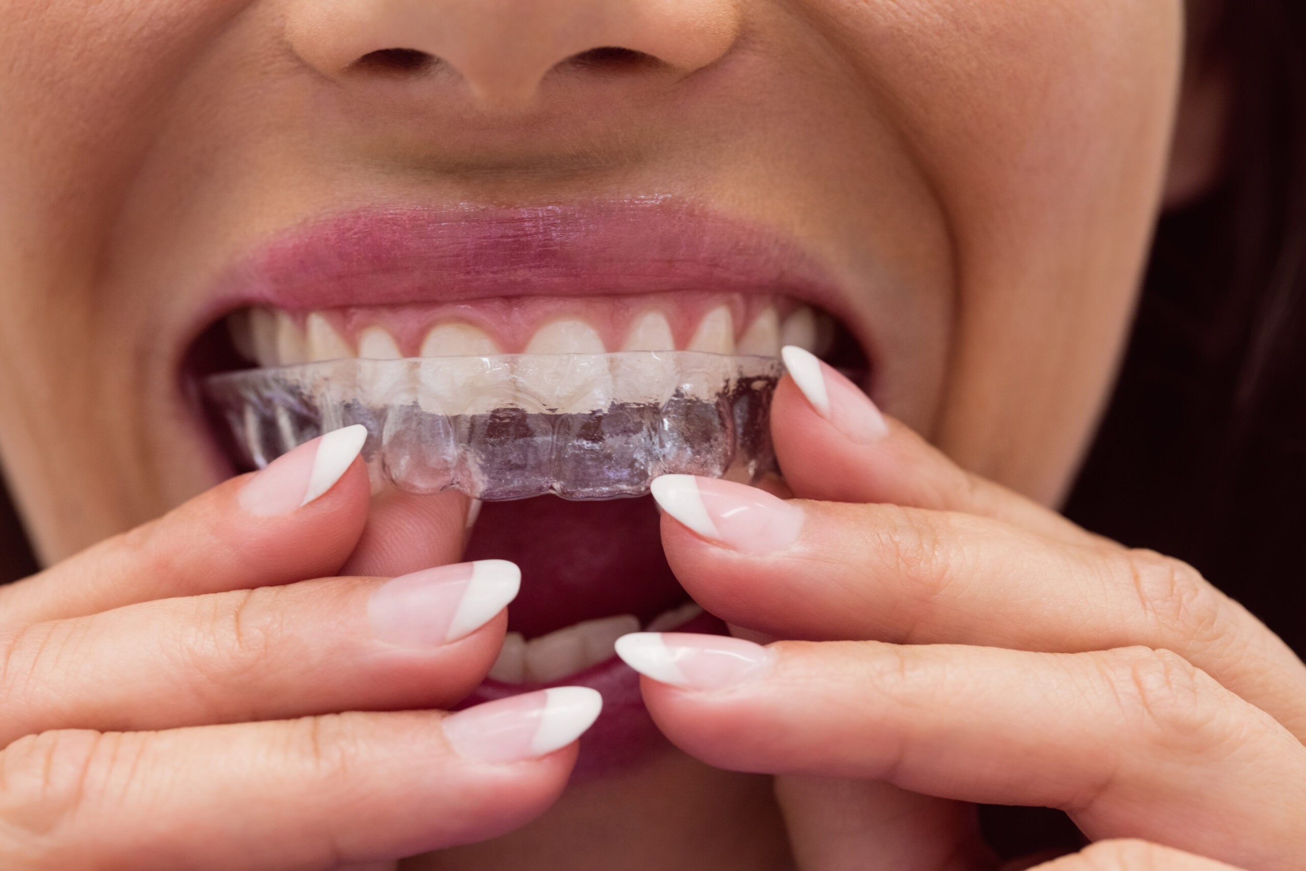 Clear Aligners: Invisible Braces for Perfect Smile