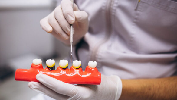 Dental Crowns: Fix Damaged Teeth Fast