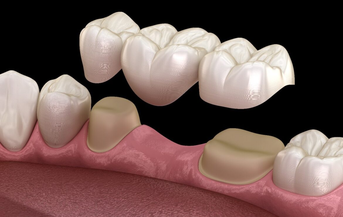 Affordable Dental Bridges Treatment – Restore Your Smile