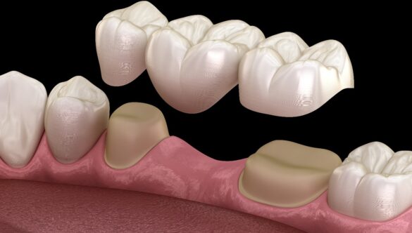 Affordable Dental Bridges Treatment – Restore Your Smile