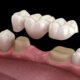 Affordable Dental Bridges Treatment – Restore Your Smile