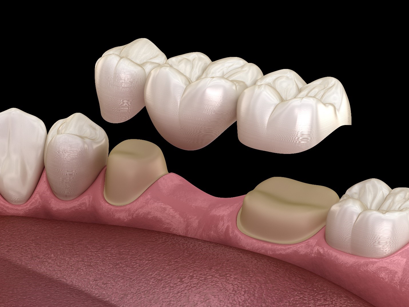Affordable Dental Bridges Treatment – Restore Your Smile